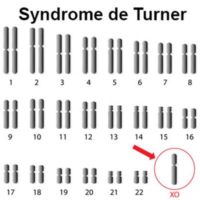 Syndrome de Turner