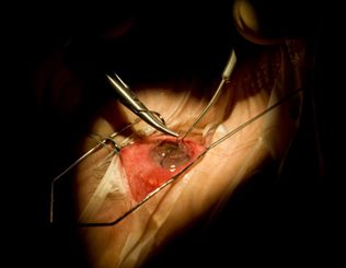 chirurgie de l'oeil