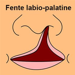 fente labio-palatine
