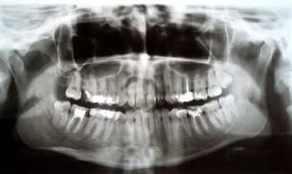 radiographie des dents