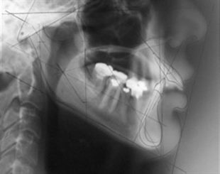 radiographie de la mâchoire