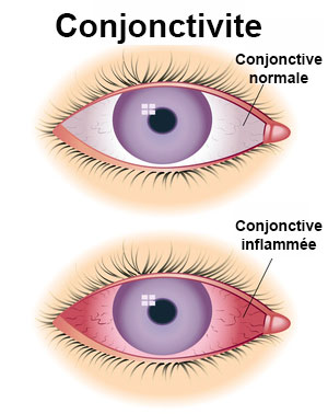 Conjonctivite Du Nourrisson Definition Docteurclic Com