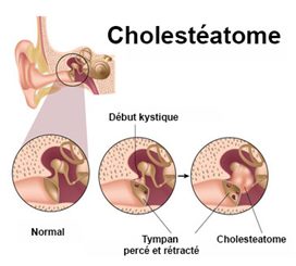 cholestéatome