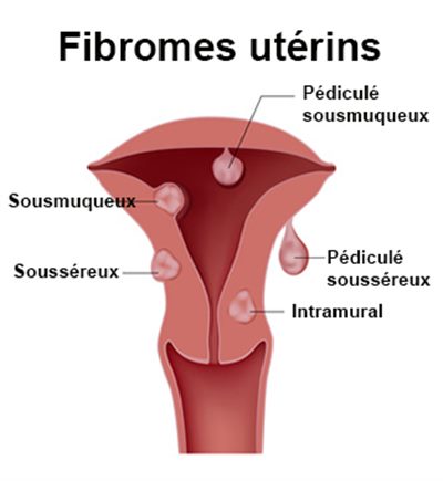 Fibrome utérin