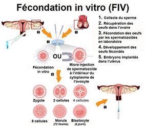 fécondation in vitro (FIV)