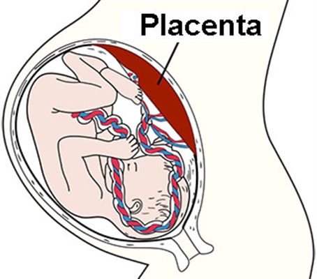 Rétention placentaire