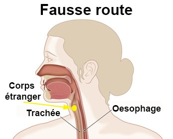 Fausse Route Symptomes Traitement Definition Docteurclic Com Fausse Route Symptomes Traitement Definition Docteurclic Com