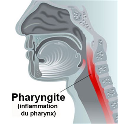 Pharyngite de l'enfant