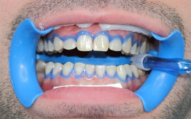 blanchiment des dents