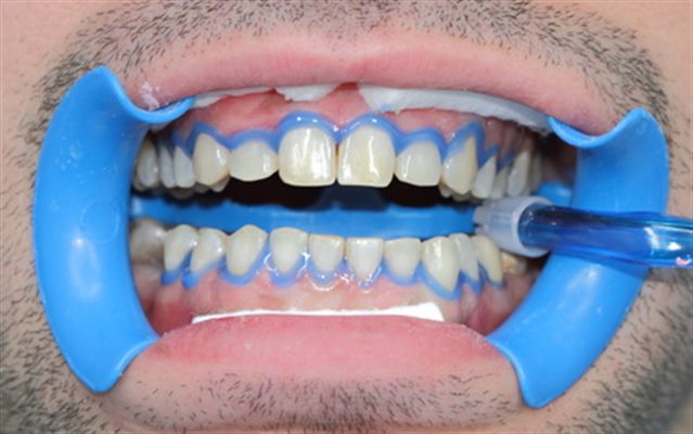 Recommendations AFSSAPS sur le blanchiment des dents