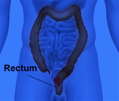 Tumeur du rectum