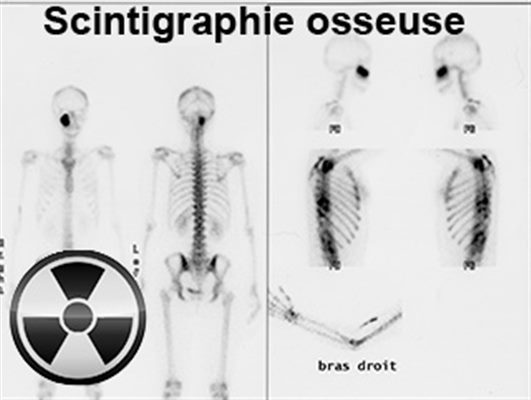 Scintigraphie osseuse examen - docteurclic.com