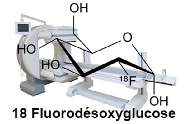 Tomographie par émission de positons (TEP ou PET Scan)