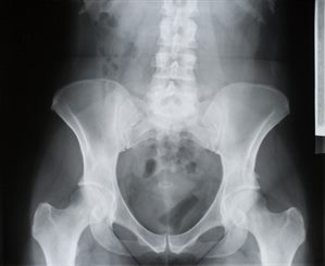 radiographie du bassin