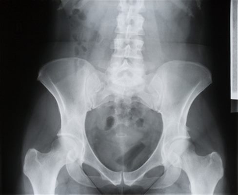 Radiographie du bassin examen - docteurclic.com