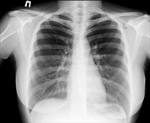 radiographie du grill costal