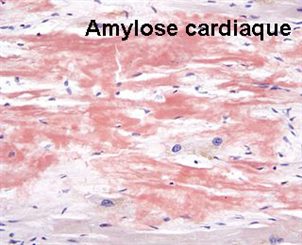 amylose cardiaque