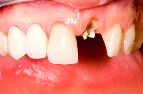 Dents cassées