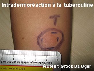 test à la tuberculine