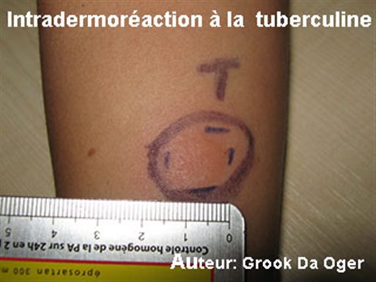 Intradermoréaction