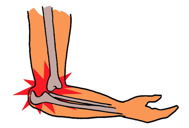 Luxation du coude : symptômes, traitement, définition ...