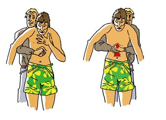 manoeuvre de hemlich