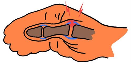 entorse du pouce