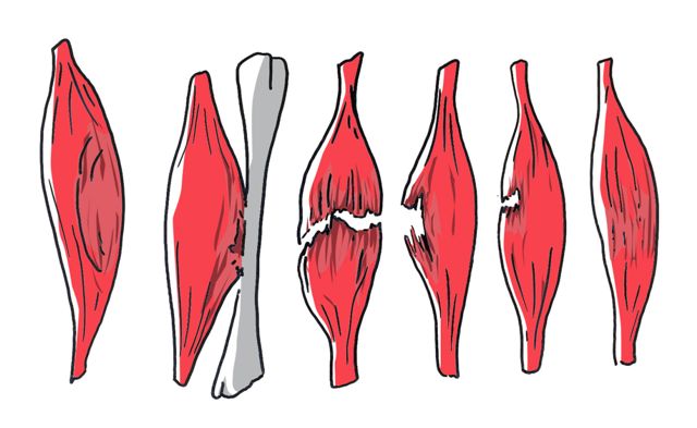 Quels sont les facteurs qui prédisposent aux claquages et déchirures musculaires