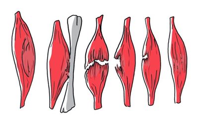 Hématome musculaire : symptômes, traitement, définition ...