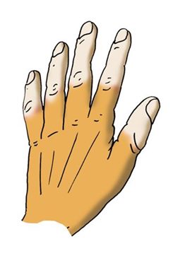 syndrome de raynaud