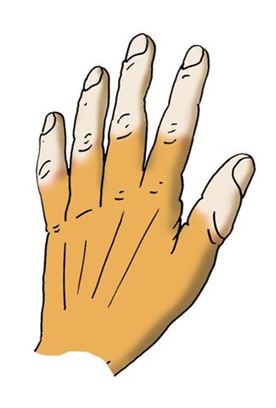Que faire en cas  de doigts blancs (maladie de Raynaud) ?