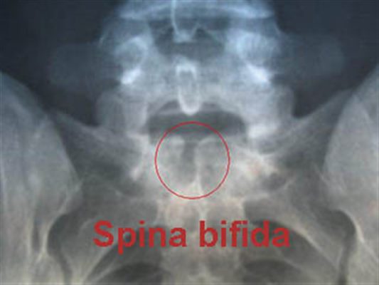 Spina-Bifida : symptômes, traitement, définition - docteurclic.com