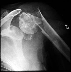fracture de l'épaule