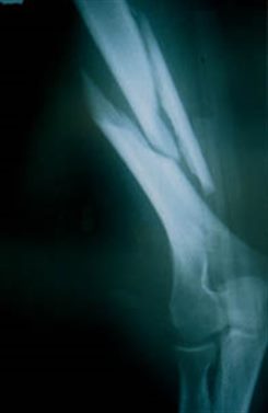 fracture de l'humérus