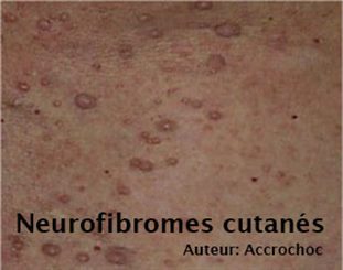 neurofibromes cutanés