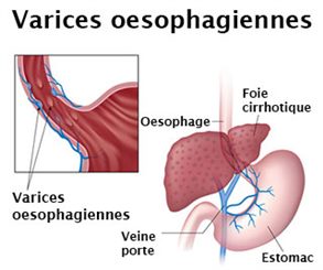 varices oesophagiennes