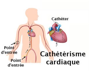 cathétérisme cardiaque
