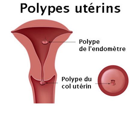 Polype utérin