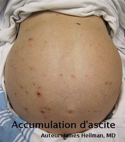 ascite
