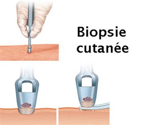 biopsie cutanée