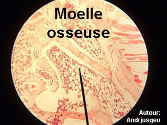 Maladies de la molle osseuse