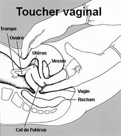 toucher vaginal