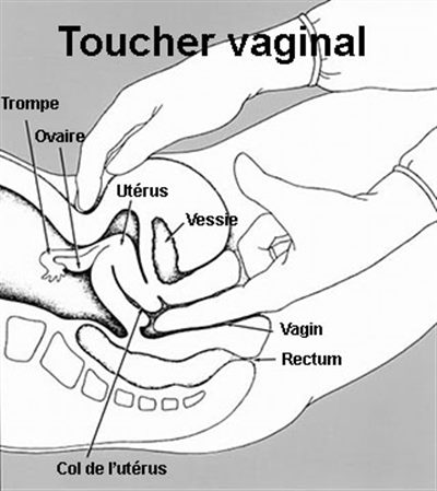 Toucher vaginal