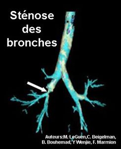sténose des bronches