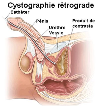 Cystographie