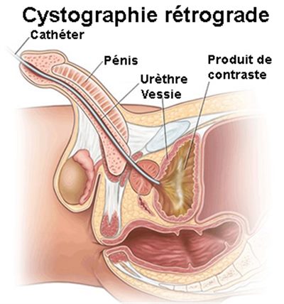 Urétrocystographie rétrograde