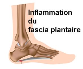 fascia plantaire