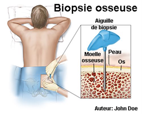 Ponction-biopsies