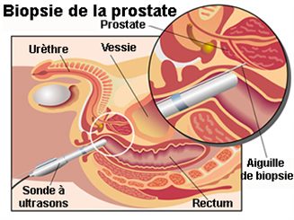 biopsie de la prostate