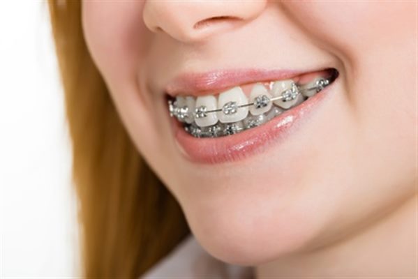 Orthodontie pour les ados